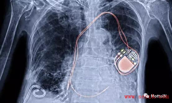 丧尽天良！DHS警告称黑客攻击植入式除颤器